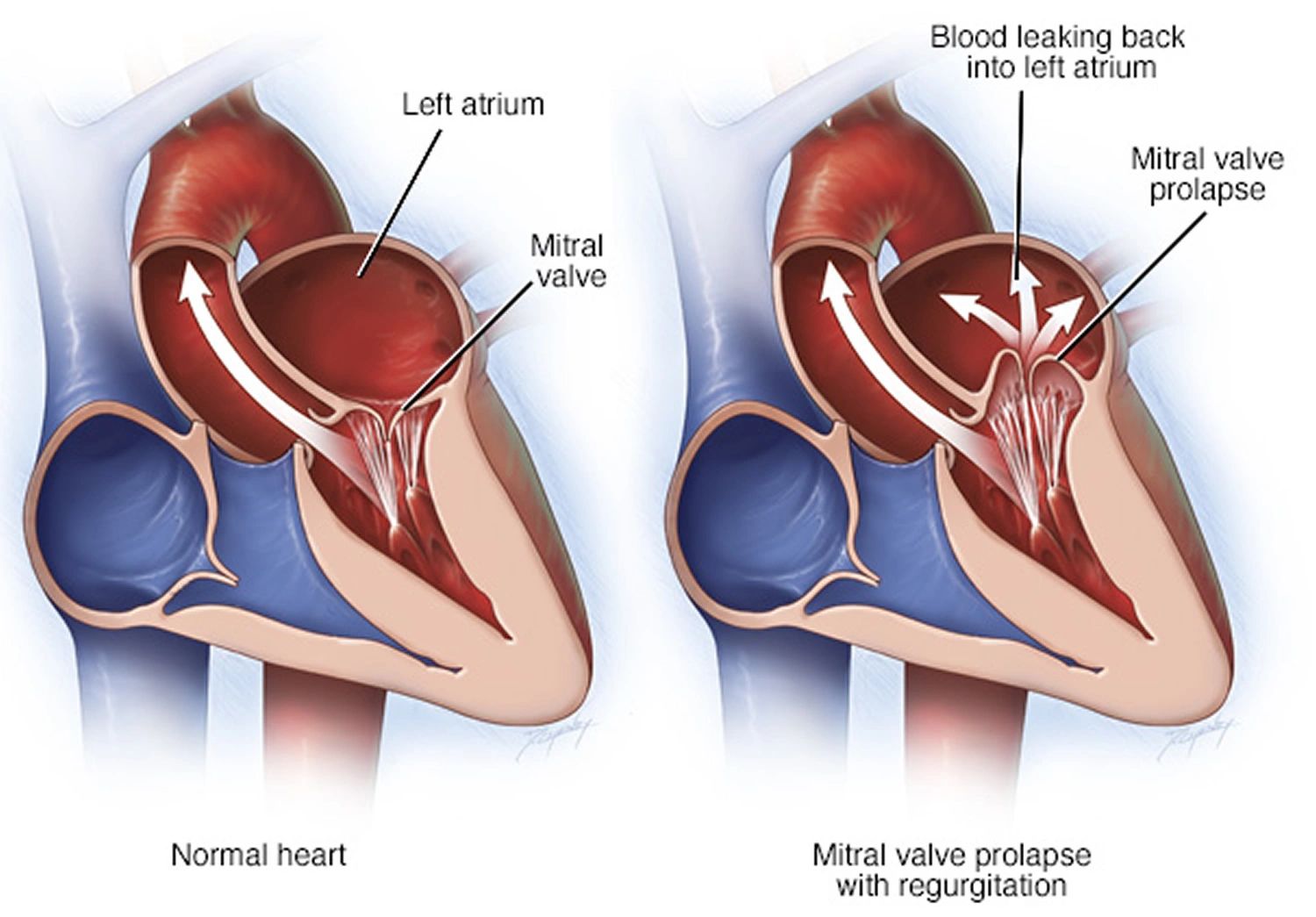 Mitral Valve Prolapse (MVP)